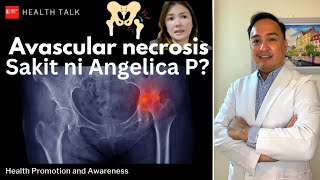 Avascular necrosis Sakit ni Angelica P Ano ito Causes risks symptoms and treatment [upl. by Meridith456]