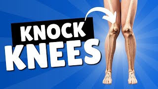 Knock Knees  Corrective Exercises and Treatment for Genu Valgum [upl. by Gautious3]