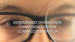 Estrabismo divergente compensado con corrección óptica [upl. by Lyj]