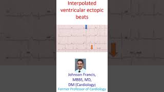 Interpolated ventricular ectopic beats [upl. by Kcajyllib]