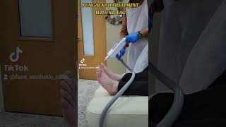 FUNGAL NAIL TREATMENT WITH ND YAG LASER dermalfiller prp skincare beauty lipfiller skinprp [upl. by Japha710]