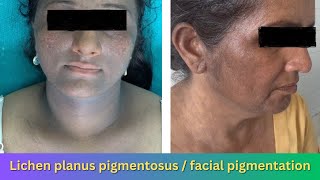 Lichen planus pigmentosus  facial pigmentation [upl. by Eissirhc74]