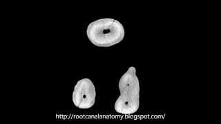 Maxillary First Molar MB2 Prof Marco Versiani [upl. by Velasco]