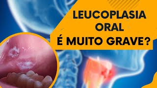 LEUCOPLASIA ORAL  MUITA ATENÇÃO PARA ESSA LESÃO NA BOCA  Dr Edinei Dias [upl. by Amice668]