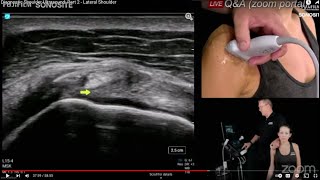 Diagnostic Shoulder Ultrasound Part 2  Lateral Shoulder [upl. by Rentschler]