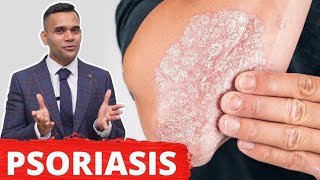 Psoriasis Treatment  The Best 2 Remedies For Psoriasis [upl. by Esinned6]