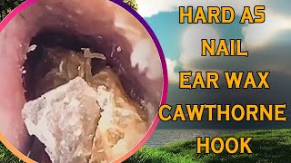 Hard as nails earwax vs cawthorne hook with ear wax removal [upl. by Eniron221]