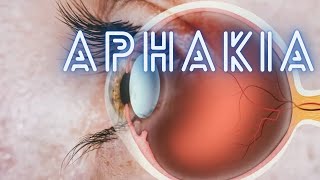 Aphakia  Ophthalmology Lecture [upl. by Erma684]