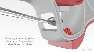 Symbios  Sinuslift Animation [upl. by Lejeune]