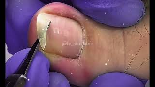 Toe nail toenails ingrowntoenail [upl. by Aielam]