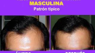 Alopecia androgenética en Guayaquil Causas formas clínicas y tratamiento CENDIACQ [upl. by Assirahs238]