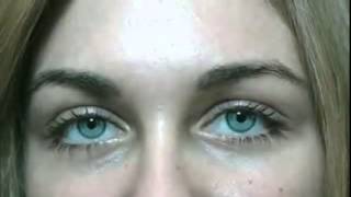 Bright Ocular surgery to change your eye color permanently to ice gray [upl. by Isied421]