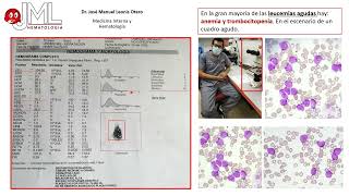 ASPIRADO DE MÉDULA ÓSEA Y CITOMETRIA DE FLUJO EN EL DIAGNÓSTICO DE LEUCEMIA AGUDA [upl. by Joacimah]