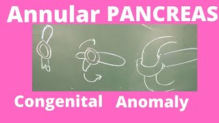 Annular pancreas  Congenital anomaly of pancreas  Embryology of Pancreas easy to write in exams [upl. by Eytak981]