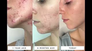 Extreme Secret tip for Acne amp Acne scars removal [upl. by Sinclare487]