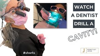 Dentist DRILLS cavitycheck out massive hole at END 👀 ASMR shorts [upl. by Vinnie469]