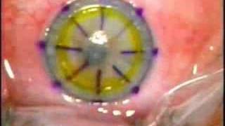 Lamellar Keratoplasty LK [upl. by Briant899]