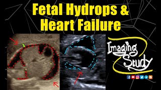 Fetal Hydrops amp Heart Failure  Ultrasound  Anomaly  Case 293 [upl. by Nahk113]