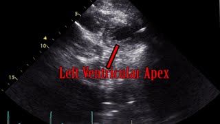 Parasternal Short Axis View Lower Apex Level  Loop [upl. by Rybma643]