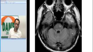 Radiology Spotters by Dr Sumer Sethi 34  Wallerian Degeneration [upl. by Cleodal270]