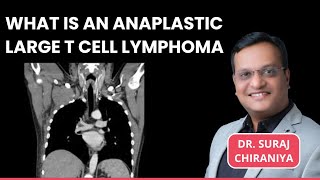 What is Anaplastic Large T Cell Lymphoma  Sign amp Symptoms Treatment Options by Dr Suraj Chiraniya [upl. by Otilopih559]