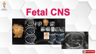 Fetal CNS [upl. by Atnoved30]