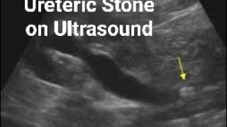 Ureteric stone on Ultrasound [upl. by Encratis]