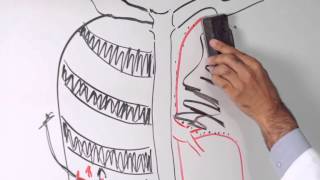 Lobectomy of Lung  Minimally Invasive Approach to Lung Cancer Surgery [upl. by Savory]