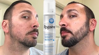 How to grow a REAL Beard  Minoxidil 4 Month Beard Journey [upl. by Akeret]