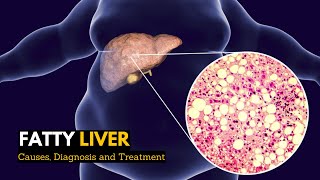 Fatty Liver Causes Signs and Symptoms Diagnosis and Treatment [upl. by Golliner]