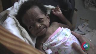 CANDOORG Project Haiti  Baby quotquotMiraclequot rescue [upl. by Moazami]