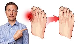 How to Fix Bunions in 3 Steps [upl. by Kersten]