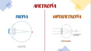 ¿POR QUÉ OCURRE LA MIOPIA Y OTROS DEFECTOS REFRACTIVOS PERLAS MÉDICAS [upl. by Ainoyek]