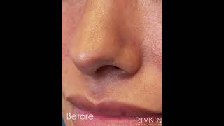 Nostril Correction nonsurgicalrhinoplasty nostril shortsviral [upl. by Orecic214]