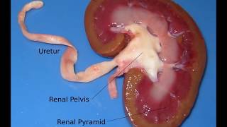 coagulative necrosis kidney gross and microscopic features for medical students [upl. by Paterson]