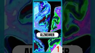 Estas son las DIFERENCIAS entre ALZHEIMER y DEMENCIA 🧠 alzheimer [upl. by Esirehs889]