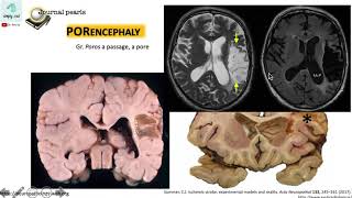 Porencephaly versus Schizencephaly 12 [upl. by Yenots]