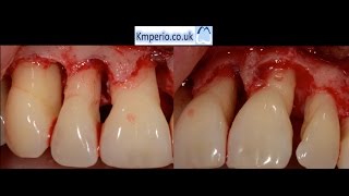 Periodontal Surgery with Regeneration for Upper Teeth [upl. by Ellehcer]