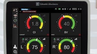 INTERMITTENT THERMODILUTION CARDIAC OUTPUT MONITORING ON HEMOSPHERE MONITOR [upl. by Zebadiah605]