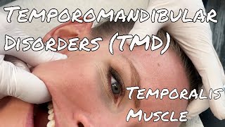 TMJ Pain  Temporalis Release  Motion Specific Release [upl. by Neenahs787]