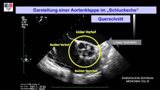 Aortenklappe im quotSchluckechoquot TEE [upl. by Ahsataj]