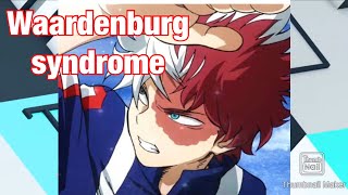 Waardenburg Syndrome [upl. by Tegan]