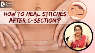 6 Tips to Take Care of Stitches amp Heal Fast After CSection DrSupritha Rangaswamy Doctors Circle [upl. by Atinod449]