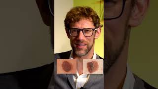 How to Spot Melanoma Early [upl. by Neelyk]