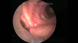 Bronchoscopy for Lung Cancer [upl. by Aynekal28]