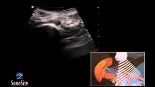 How To Abdominal Aorta Ultrasound 3D Video [upl. by Yann642]