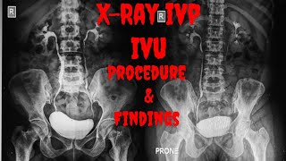 XRAY IVP  XRAY IVU Procedure Indications Findings  Intravenous Urogram  Intravenous Pyelogram [upl. by Dola]