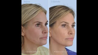 A Patients Facelift Journey [upl. by Jenei]