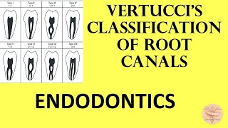 Vertucci classification of root canal  With Mnemonics [upl. by Arnaldo]