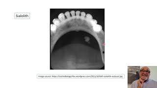 Non Dental Radiopacities Seen on intra oral Radiographs and OPG [upl. by Yenahpets]